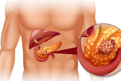 Diseases-of-Pancreas