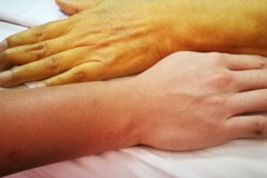 Jaundice-Stomach-Pain-Diarrhea