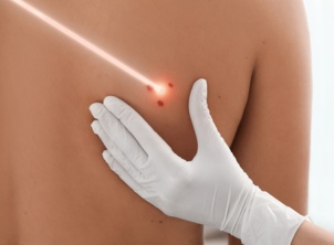 laser mole removal