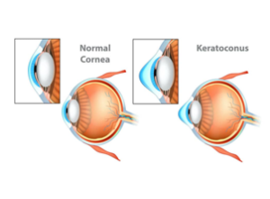 Cornea