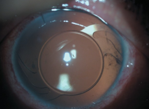 Advanced Cataract Surgery