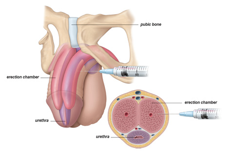 Transurethral resection of the prostate TURP