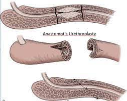 Percutaneous nephrolithotomy PCNL