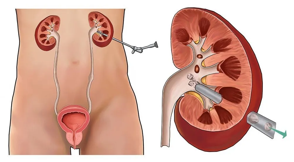 Percutaneous nephrolithotomy PCNL